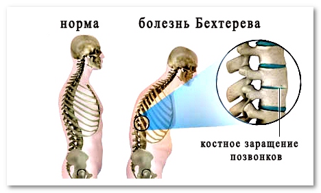 Упражнения для спины Бубновского в домашних условиях